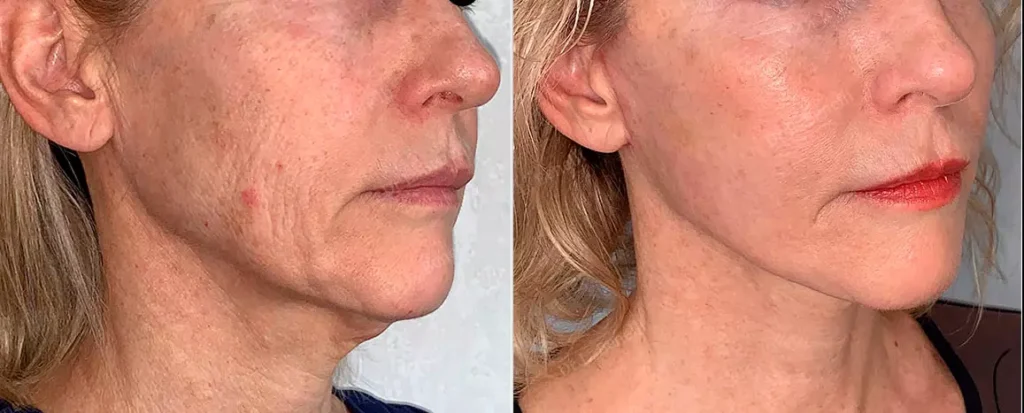 Renova Vitta - Camilla fonseca